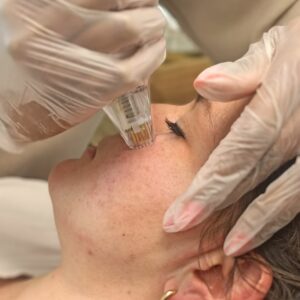 formation-radiofrequence-microneedling-potenza-clem-lille