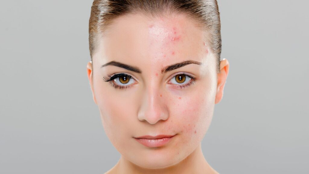 Cicatrices d’acné : comment s’en débarrasser pour de bon !