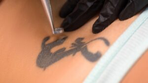 Détatouage : peut-on effacer tous les types de tatouage ?