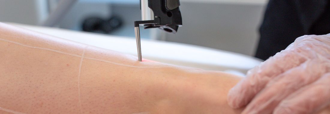 epilation-jambes-laser-clem-lille