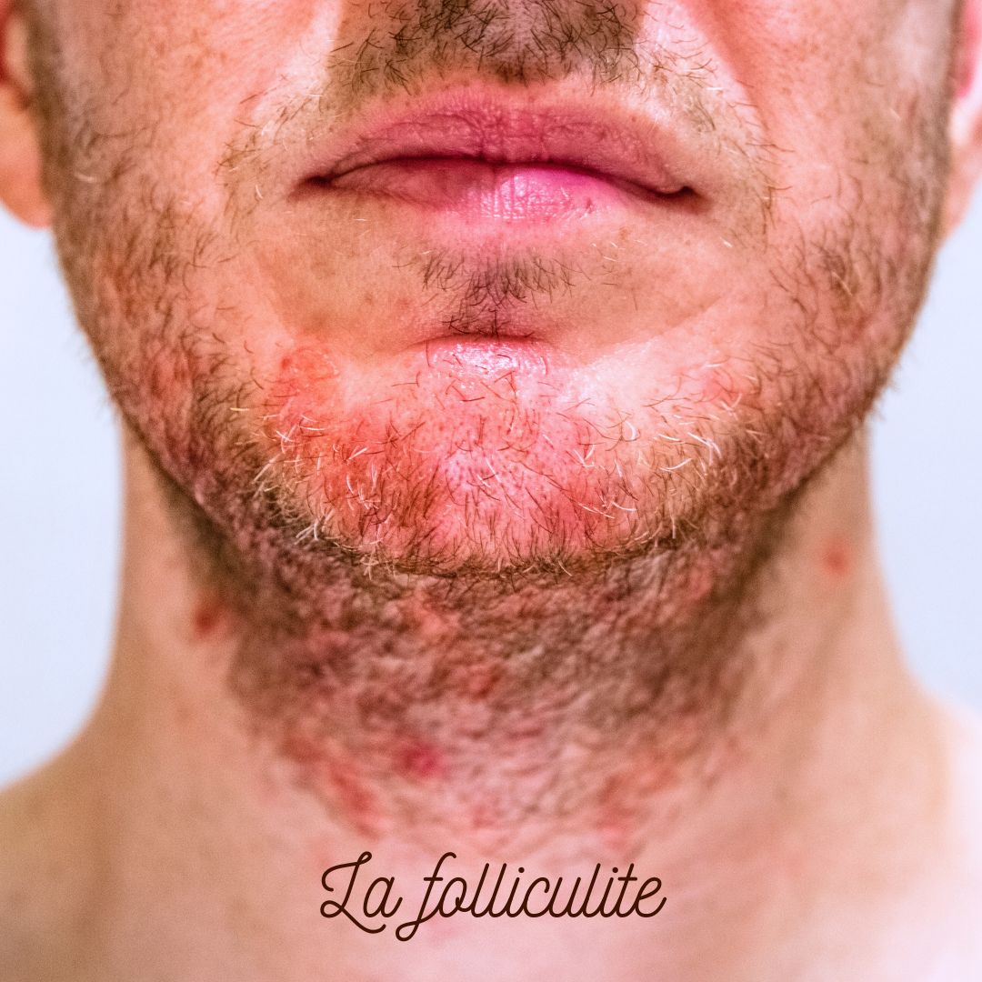 Epilation laser définitive chez l’homme CLEM