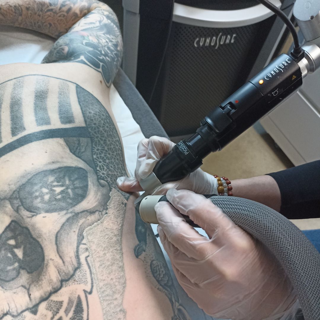 Détatouage Laser à la Clinique Clem à Lille