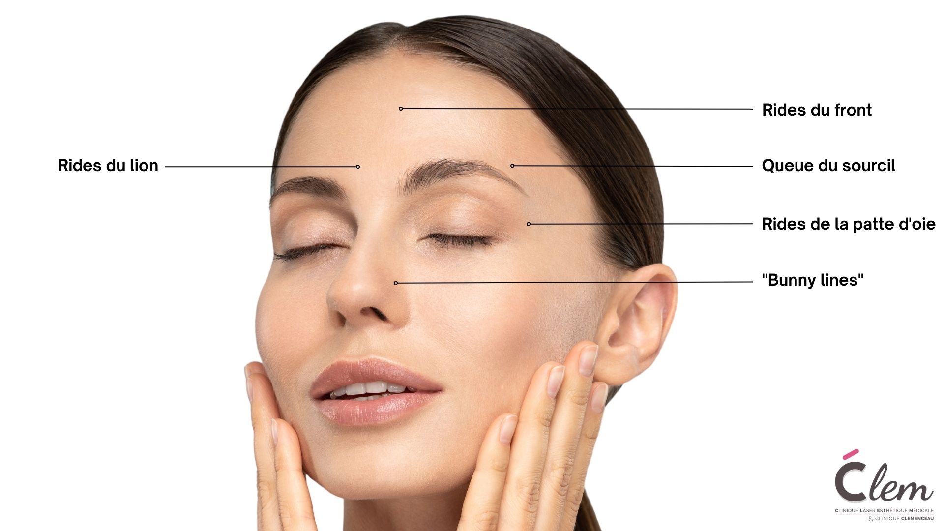 Zones d'injections au Botox à la clinique CLEM