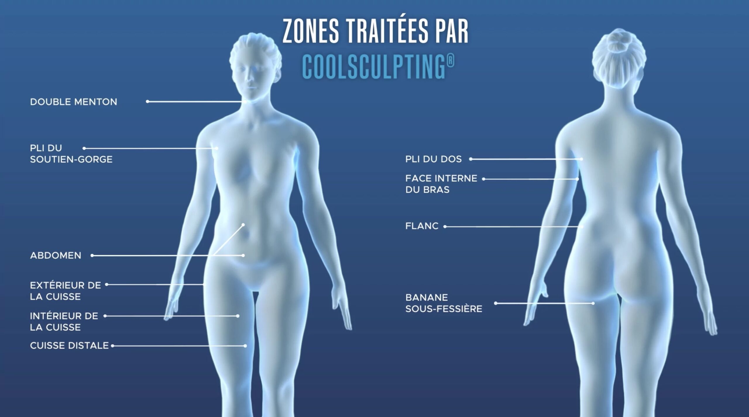 Zones de traitement cryolipolyse CoolSculpting Elite