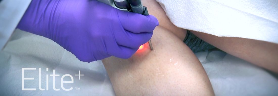 Traitement des varicosités avec le laser Elite+ à la clinique CLEM de Lille