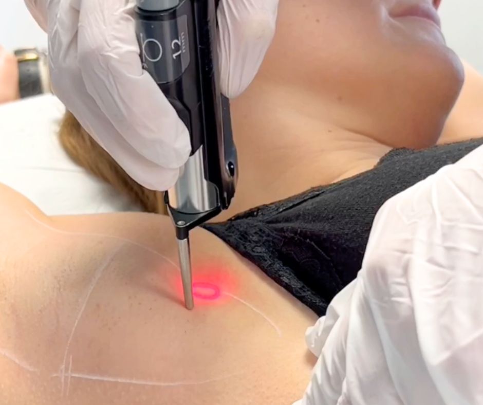 Epilation au Laser des Aisselles à Lille et Arras